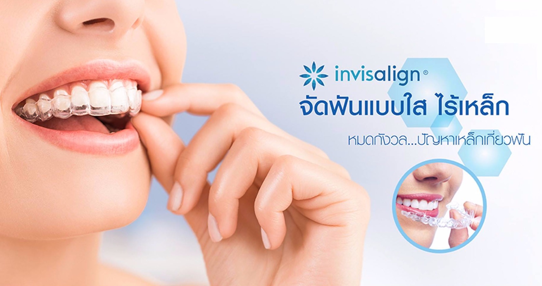 จัดฟันใส Invisalign