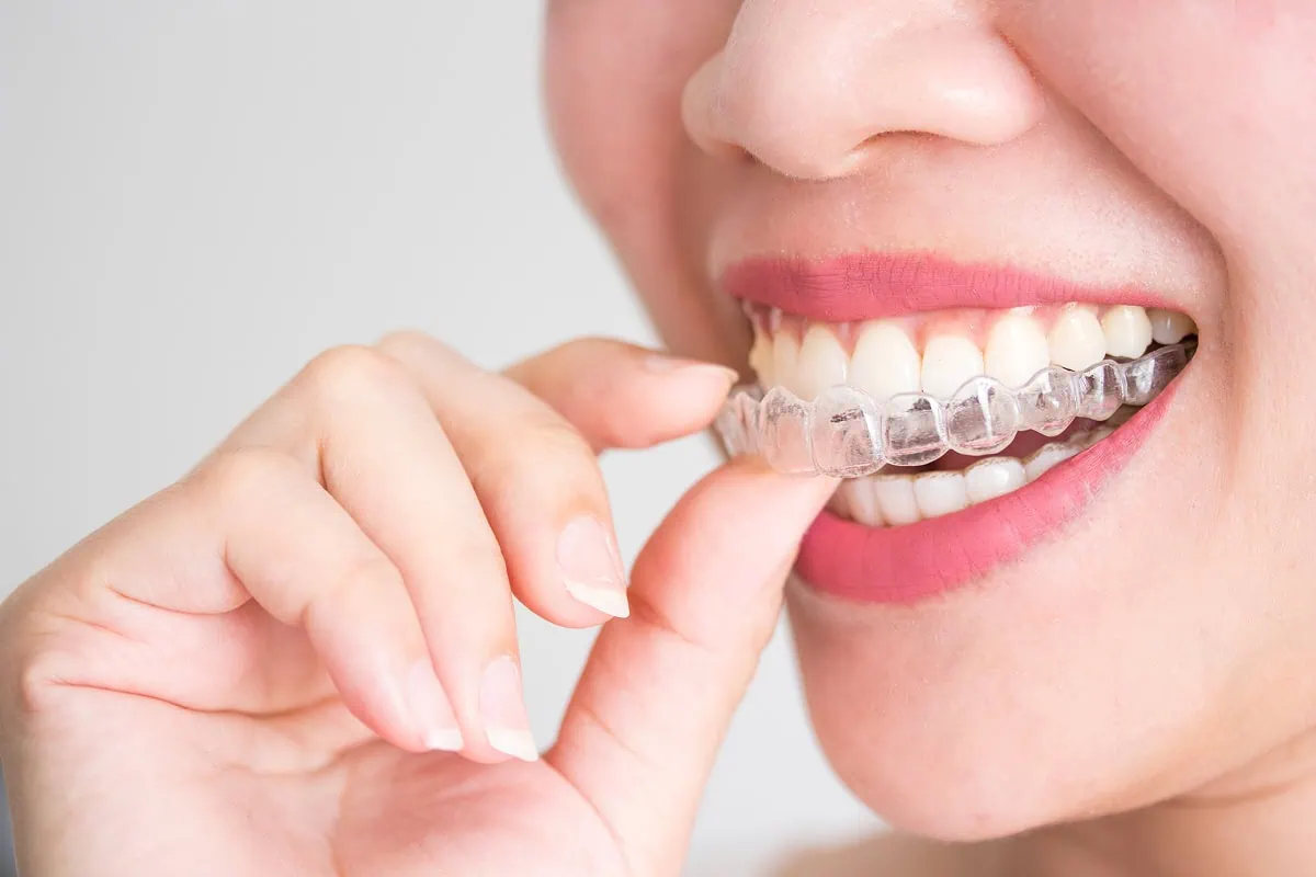 จัดฟันใส Invisalign