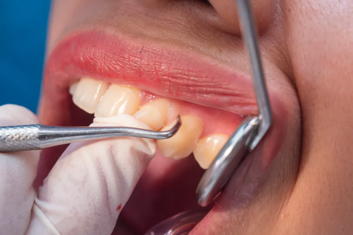 ขูดหินปูน ขัดฟัน ลดคราบสะสม