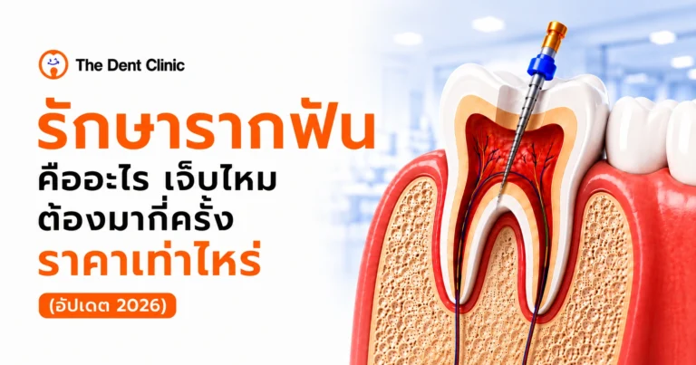 ภาพประกอบการรักษารากฟัน แสดงภาพตัดขวางของฟันขณะใช้เครื่องมือทำความสะอาดคลองรากฟัน โดย The Dent Clinic