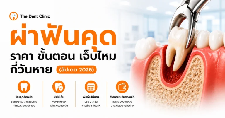 ภาพประกอบการผ่าฟันคุด แสดงภาพตัดขวางของฟันคุดขณะถูกถอนด้วยคีมทันตกรรม โดย The Dent Clinic