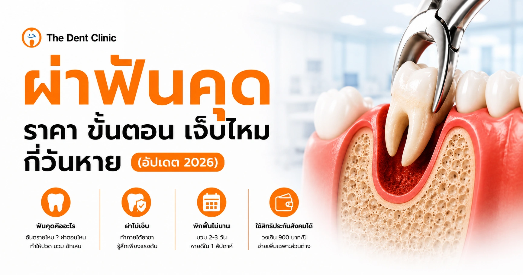 ภาพประกอบการผ่าฟันคุด แสดงภาพตัดขวางของฟันคุดขณะถูกถอนด้วยคีมทันตกรรม โดย The Dent Clinic